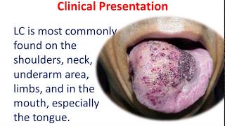 10 MIN REVISION Lymphangioma Circumscriptum [upl. by Nitsuj]