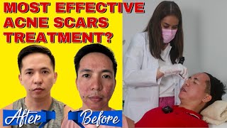 CO2 FRACTIONAL LASER  ACNE SCAR TREATMENT  BEFORE AND AFTER  HONEST REVIEW [upl. by Alimat]