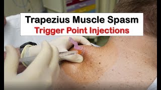 Trapezius Muscle Spasm Trigger Point Injection [upl. by Ennylyak]