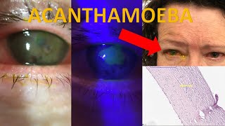 Acanthamoeba keratitis Severe case diagnosis investigation management Evidencebased series [upl. by Genovera315]