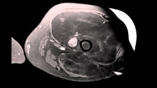 Well differentiated Liposarcoma Left Thigh [upl. by Akapol]