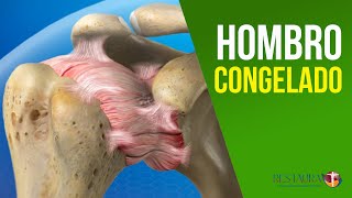 Hombro congelado  Capsulitis adhesiva del hombro  Causas y tratamiento [upl. by Rovit]