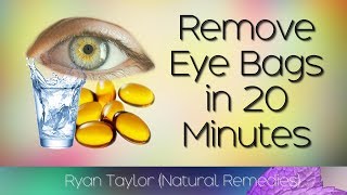 How To Remove Eye Bags 20 Minute Natural Remedies [upl. by Cyrano638]