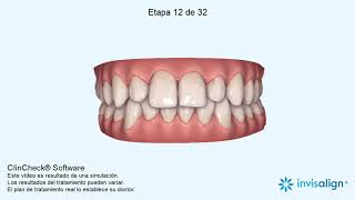 Invisalign ClinCheck Simulación tratamiento Cierre de diastema [upl. by Eneiluj]