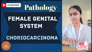 What Is CHORIOCARCINOMA In Pathology [upl. by Nalrah714]