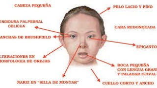 Síndrome de Down Características 📌video bien explicado Psicología [upl. by Cirilla887]