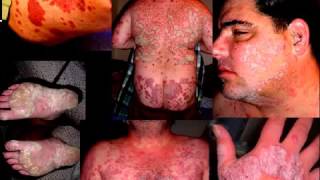 Stelara Side Effects Stelara causes drug induced psoriasis Biologic problems big Eng subtitles [upl. by Arata]