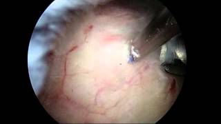 Arthroscopic removal of calcium deposit from shoulder calcific tendonitis [upl. by Adnarrim]