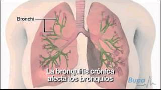 Enfermedad pulmonar obstructiva crónica EPOC [upl. by Llereg449]