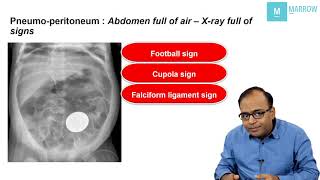 CONCEPTUAL RADIOLOGY ON MARROW  X ray signs in pneumoperitoneum [upl. by Bajaj836]