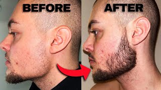 Minoxidil Beard Before And After  2 Months Progress [upl. by Glover367]