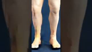 Knee HyperextensionEhicordfilm [upl. by Philippine134]