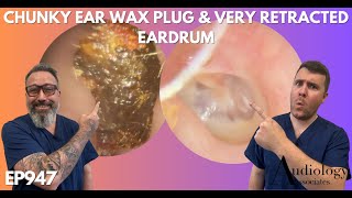 SHOCKED BY THE SIZE OF THIS EAR WAX PLUG  EP947 [upl. by Benedetto144]