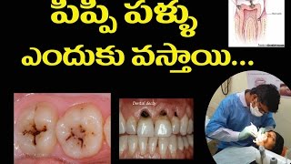 Pippi pannu enduku vasthundhi Dental Caries ante emitiby veerashekar vennampalli [upl. by Adolph]