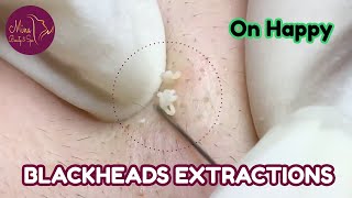 BLACKHEADS EXTRACTIONS on Happy    Josefa M REINA awesome Mina Spa [upl. by Anaher]