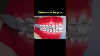 Ortho Treatment open bite العلاج التقويم للعظه المفتوحه 🎖️👌 [upl. by Breger]