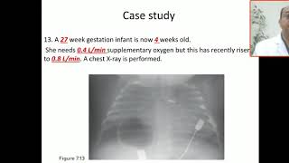 Case 94 BPD bronchopulmonary dysplasia CLD chronic lung disease  PDA ligation steroid treatment [upl. by Niawtna]