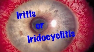 Medical Video Lecture Ophthalmology Iridocyclitis or Iritis Made simple [upl. by Cave149]