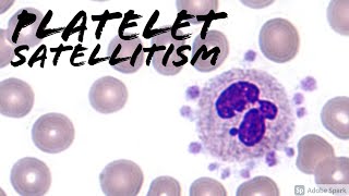 Platelet SatellitismSatellitosis from EDTA amp Pseudothrombocytopenia Hemepath amp Hematology [upl. by Rather]