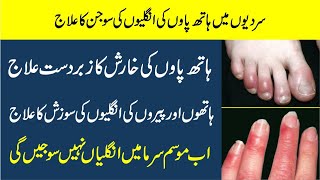 Hathon or paon ki ungliyon Ki Sojan Ka ilaj  Fingers swelling in winter  chilblain treatment urdu [upl. by Attelrac427]