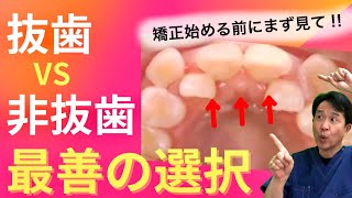 【歯列矯正】抜歯vs非抜歯！？どっちがいいの？歯医者が解説‼︎ [upl. by Behka]