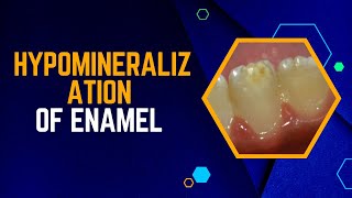 Hypomineralization of Enamel 3 Unpopular Treatments [upl. by Haidej]