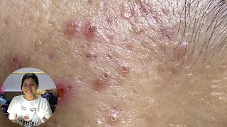 Acne Treatment Huong Da Nang The video has been lost for a long time Remove Blackheads [upl. by Edbert]