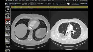 STR Cardiothoracic Case Webinar 412021 [upl. by Ham131]