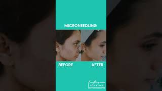 Microneedling  Before amp After [upl. by Cilka133]