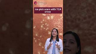 Ice Pick Scars Treatment  Ice Pick Scars TCA Cross  Acne Scar Treatment in Noida  Skinlogics [upl. by Cayser496]