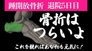 骨折して元気なくしているあなたに！骨折者から辛い気持ちを激白してくれました！骨折 骨折を早く治す 超音波 踵骨 第５中足骨骨折 [upl. by Dasie]