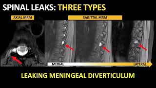 Algorithmic Multimodality Approach to Diagnosis and Treatment of Spinal CSF Leak [upl. by Mair]