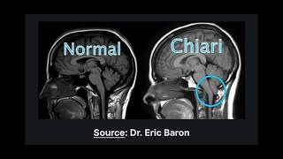 Sindrome di Budd Chiari e nevralgia occipitale [upl. by Anuahsat]