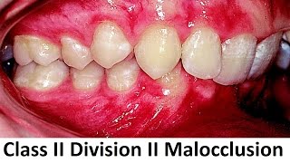 Can Class II Division II of Malocclusion Be Treated With Orthotropics by Prof John Mew [upl. by Levan161]