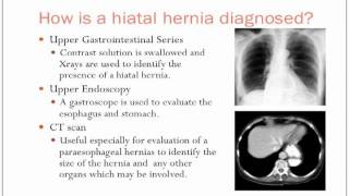 Hiatal Hernias [upl. by Dilks932]