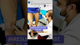 🏩 Resultados Cirugía de varices varicosevein escleroterapia 📲593995178395 [upl. by Haissem585]