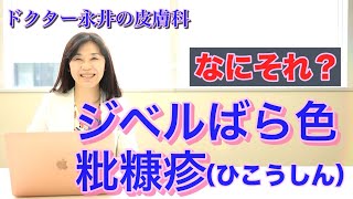 【ドクター永井の皮膚科】 なにそれ？ジベルばら色粃糠疹 [upl. by Zsuedat]