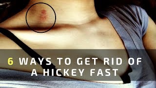 6 Ways to Get Rid of a Hickey Fast and Easy Overnight [upl. by Ahsemo]