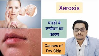 Causes of Dry Skin  Part 1 चमड़ी के रूखेपन का कारण  Xerosis  Xeroderma dryskin Winter Skin Care [upl. by Rothwell]