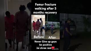 Femur fracture Recovery femur femurbone doctor nevergiveup staystrong motivation tibia bones [upl. by Zacek]