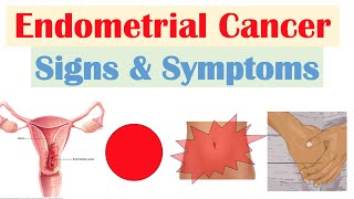 Endometrial Cancer Signs amp Symptoms amp Why They Occur [upl. by Nava272]