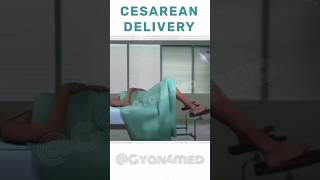 Cesarean Section Delivery  C section [upl. by Nere959]