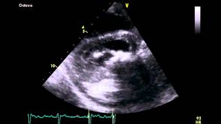 Severe Mitral Stenosis  Transthoracic Echocardiogram TTE [upl. by Morel]