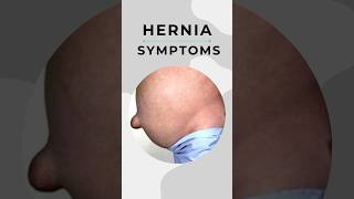 Hernia symptoms I Problems due to Hernia 7428617074 [upl. by Anek]