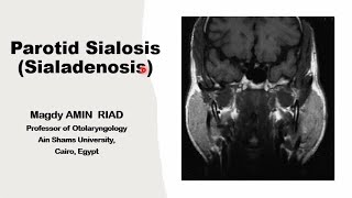 Parotid Sialosis Salivary Sialoadenosis [upl. by Aikenahs]