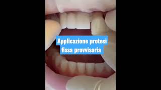 Applicazione protesi dentale fissa provvisoria [upl. by Linkoski]