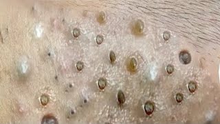 Big Cystic Acne Blackheads Extraction Blackheads amp Milia Whiteheads Removal Pimple Popping  8371 [upl. by Morell]