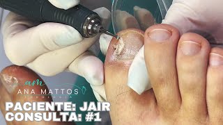 Coleta de Fungo  Laser Terapia  Aplicação de Ácido  Paciente Jair Consulta 1 [upl. by Nidorf9]