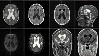 Septum pellucidum tumor differential diagnosis [upl. by Jamal]