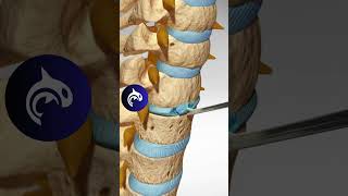 See how an Artificial Cervical Disc Replacement of the Spine works in 3D animation [upl. by Mannes]